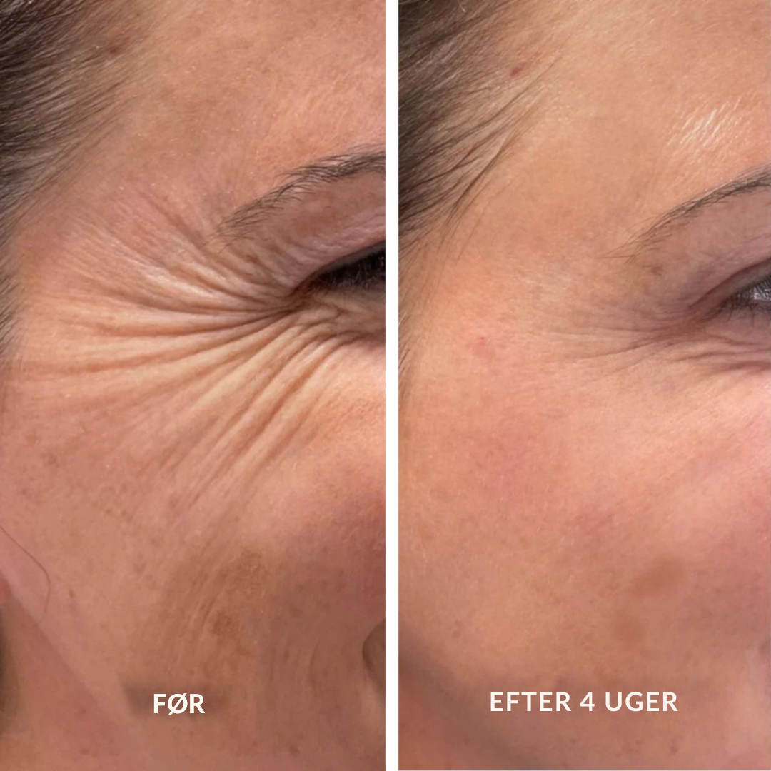 Retinal A-Shot ™ – Den blide koreanske hudfornyelse